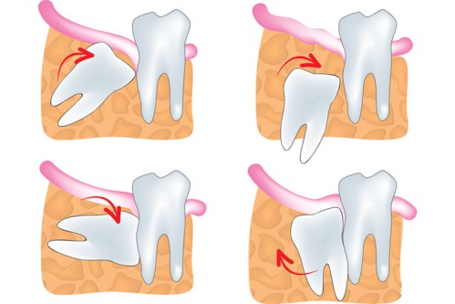 Các kiểu răng khôn mọc lệch